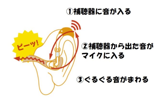 補聴器を使っている最中に、ピーピーと音が漏れている場合（ハウリング）は、イヤモールドで音漏れが防げる